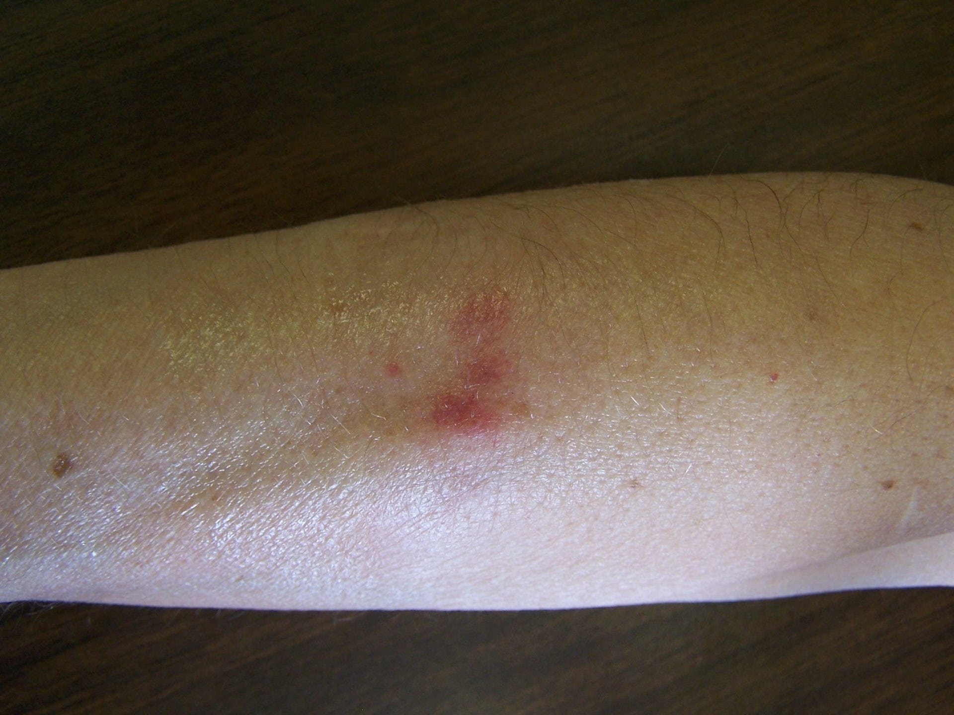 sore pink patch on the white skin of one arm