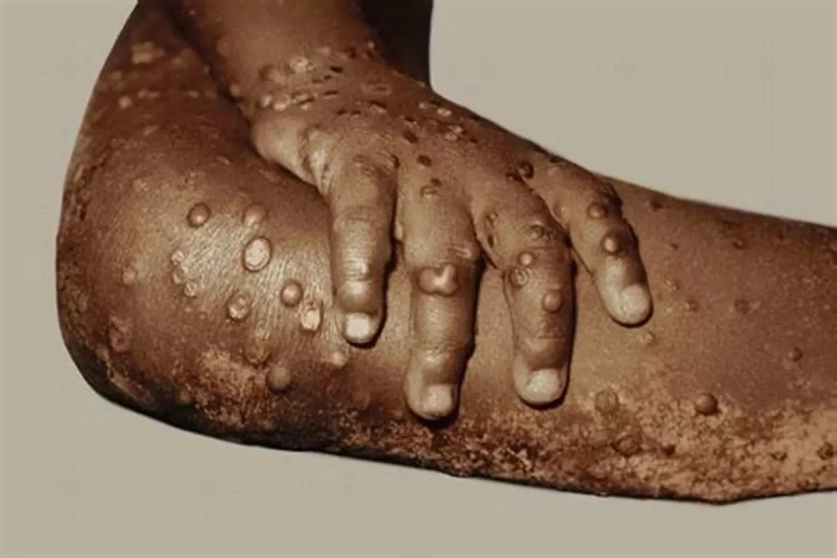 monkeypox case,Symptoms and treatment