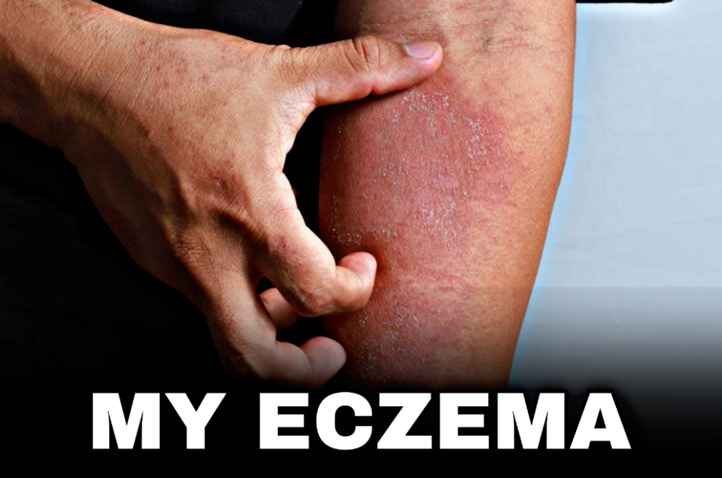 What is Causing My Eczema? Unveiling the Triggers and Factors