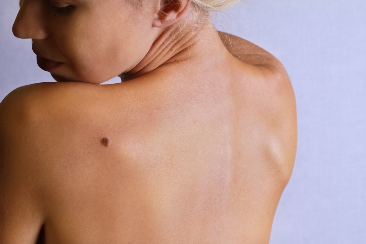 Young woman looking at a birthmark on her back, skin.  Benign mole check.