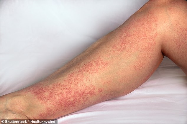 Meningococcus is known to cause a dark purple-red rash (above), but doctors cautioned that other symptoms, such as fever and stiff joints, need to be monitored.